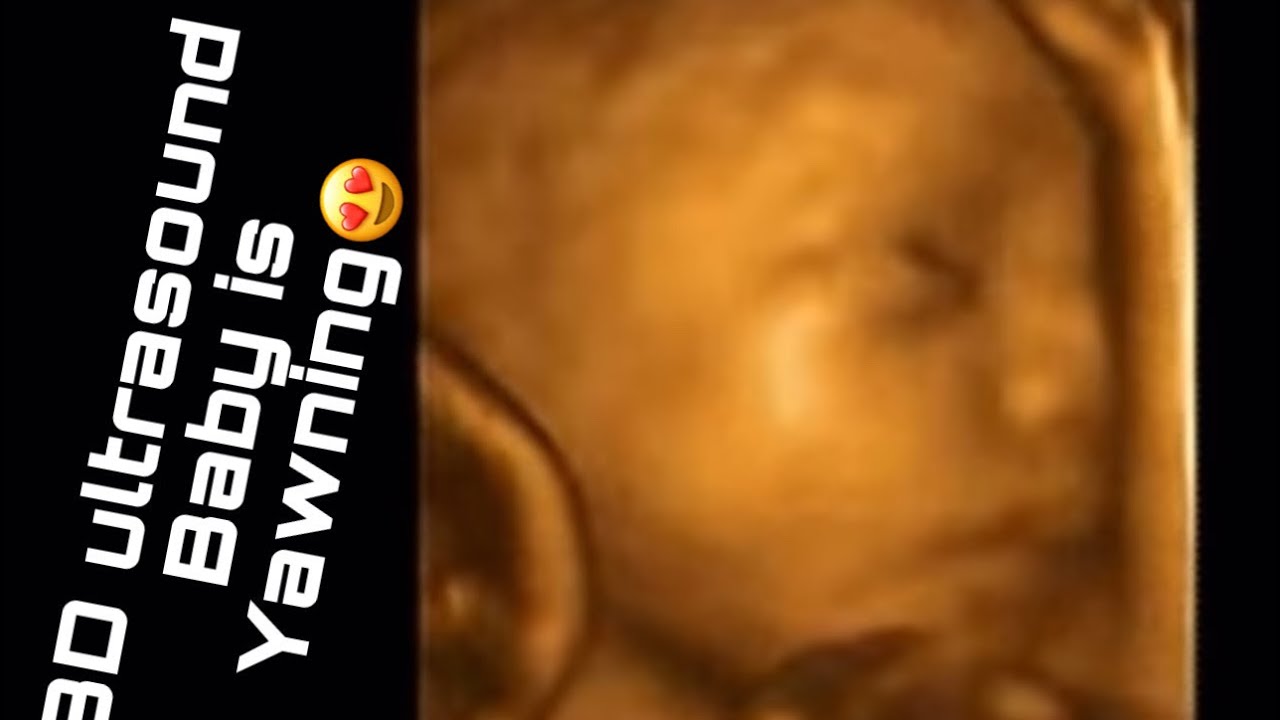 3D ultrasound 30 weeks #pregnancy | baby Yawning 😍| #gender #babygirl # ...