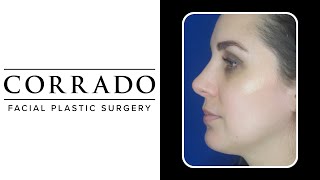 Dorsal Hump and Bulbous Tip Rhinoplasty: Before & After Pictures | Dr. Anthony Corrado