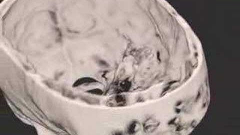 CT scan volume rendering