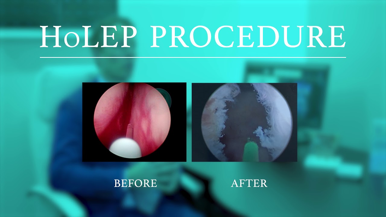 Holmium Laser Enucleation of the Prostate (HoLEP)
