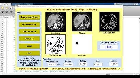 Matlab Code for LIVER TUMOR DETECTION Using Image Processing Full Project Source Code