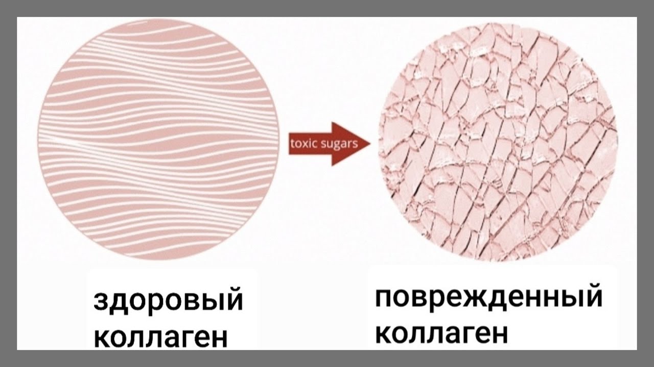 Болезнь коллагена. Гликирование коллагена. Гликация. Гликация кожи лица. Гликация тканей.