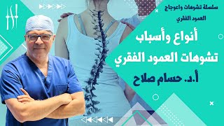 ما هي أسباب وأنواع تشوهات العمود الفقري I دكتور حسام صلاح أستاذ جراحة العظام و العمود الفقري