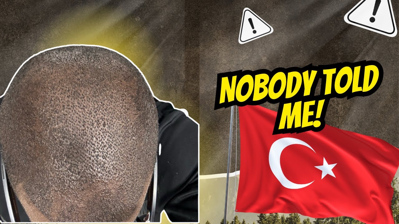 👉🏾Things I WISH I Knew Before Getting a Hair Transplant in Turkey | Heva Clinic