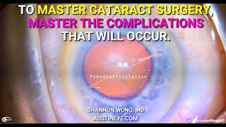 Want to MASTER Cataract Surgery?  Then MASTER THE COMPLICATIONS that occur. #STANDBYTOGETSOME