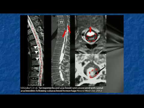 Video: Anomalie Nell'ultrastruttura Del Midollo Spinale In Un Modello Di Ratto Della Siringomielia Post-traumatica