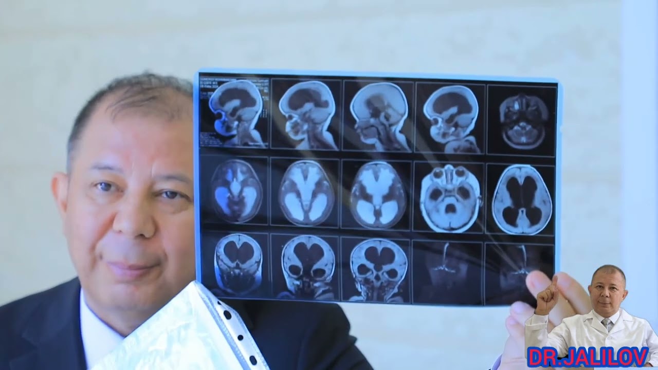 GIDROSEFALIYA// 70% MIYADA SUV TO'PLANGAN 😱