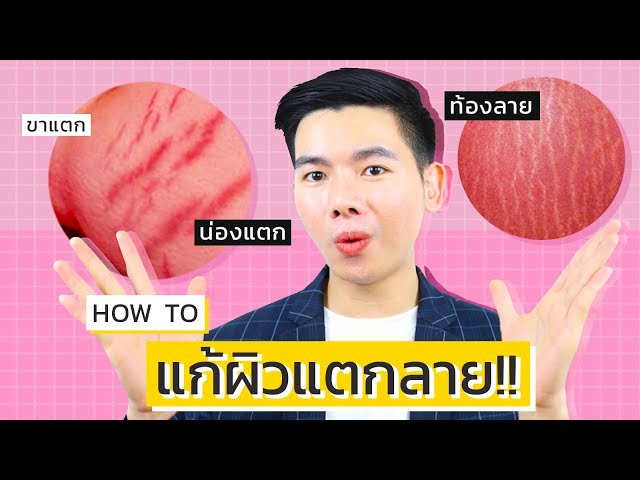 3 วิธีรักษารอยแตกลาย ก้นลาย ขาลาย ท้องลาย !! L นุชา Happy Nucha - Youtube