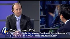 Replacing Missing Teeth with Dental Implants with Fort Worth, TX dentist Clark Damon, DDS 