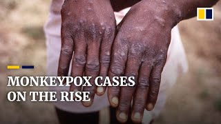 What is monkeypox and should we be worried that it’s spreading?