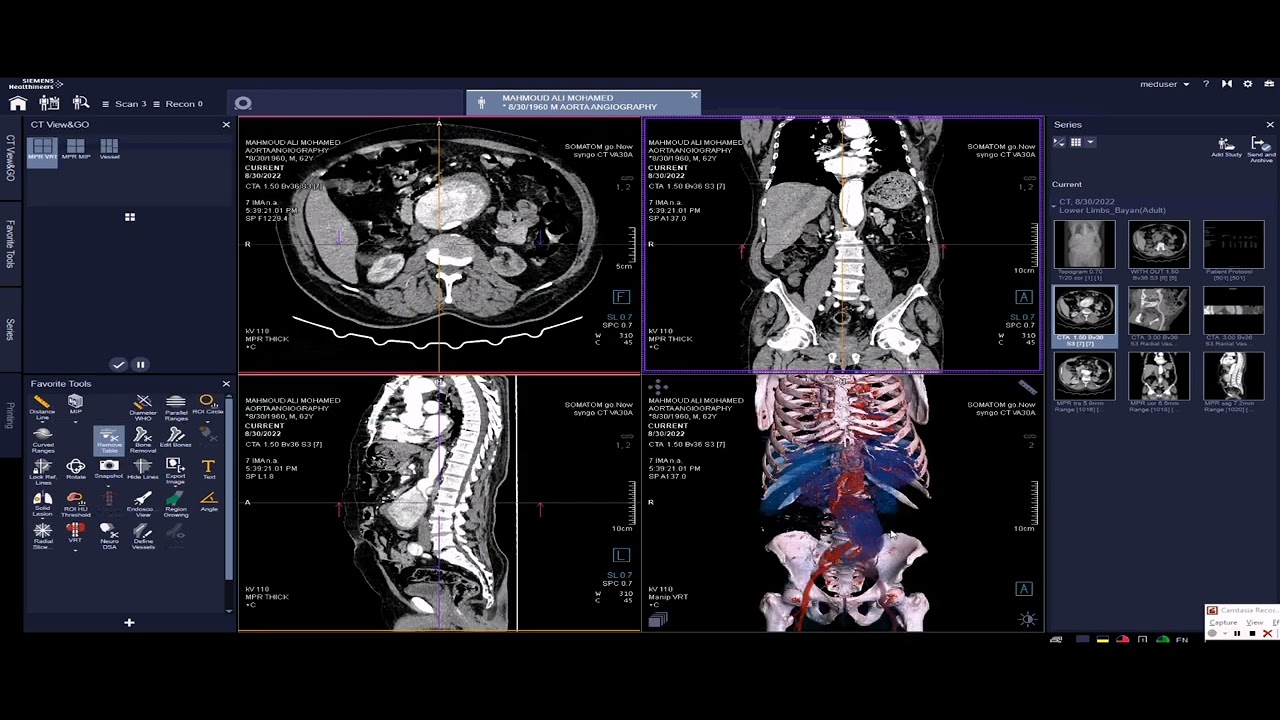 أشعة مقطعية على شرايين البطن Aortic angiography