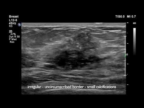 Breast Ultrasound   cancer 1