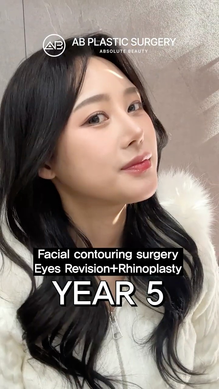 5 Years After Facial Surgery… Still Looks This Good #shorts