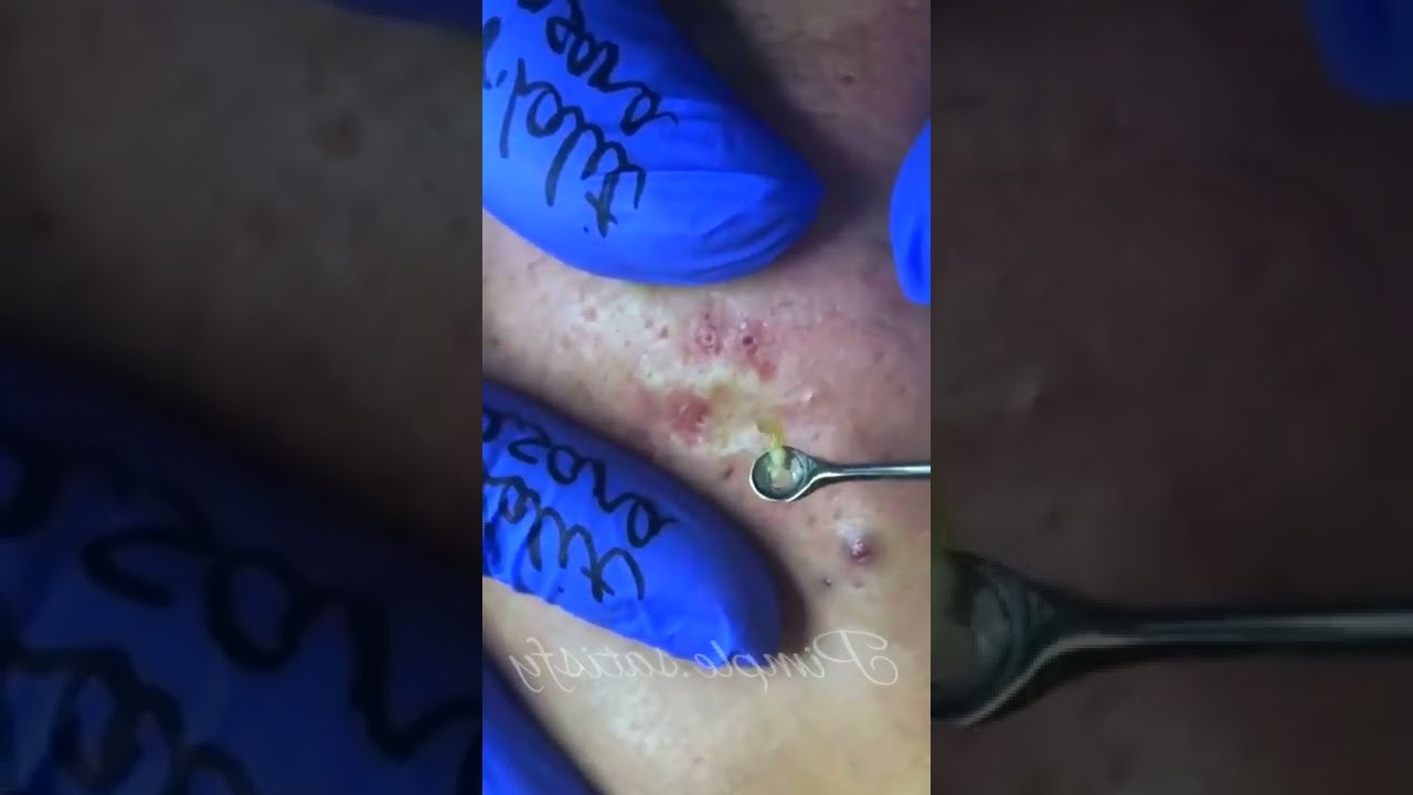Blackhead Whitehead Removal Youtube 14