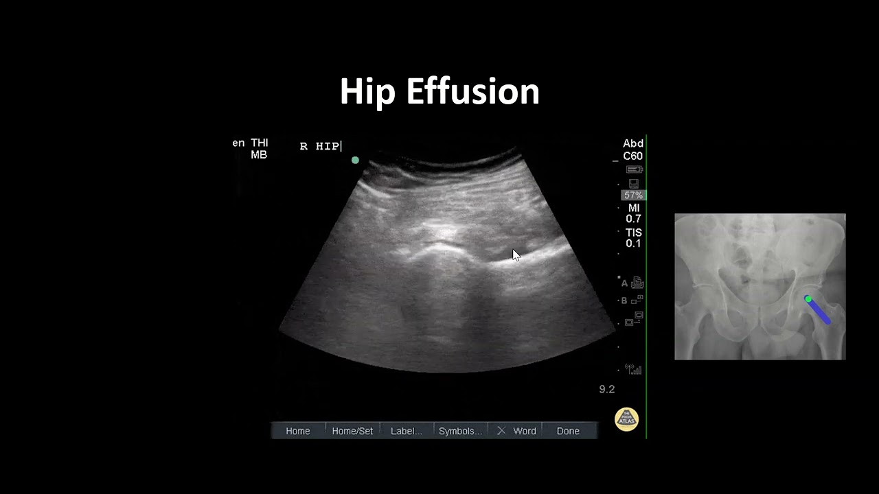 Hip Effusion