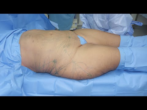 Video: Liposukcija - Pregledi, Prije I Poslije