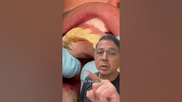 Front Tooth Extraction (Replacing Missing Tooth INSTANTLY) | View Mobile Dental #shorts