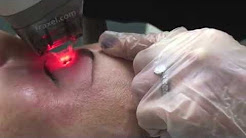 Fraxel Laser for Skin Around Eyes