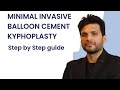 MINIMAL INVASIVE BALLOON CEMENT KYPHOPLASTY #kyphoplasty #spinefracturesurgery #neurosurgeon #spine 