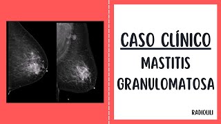 Granulomatous Mastitis: Clinical Case Granulomatous Mastitis: Clinical Case