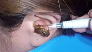 The Most Massive Earwax Removed in One Scoop screenshot 1