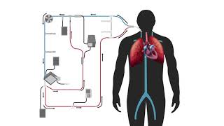 Modified Thermodilution in Extracorporeal Therapy