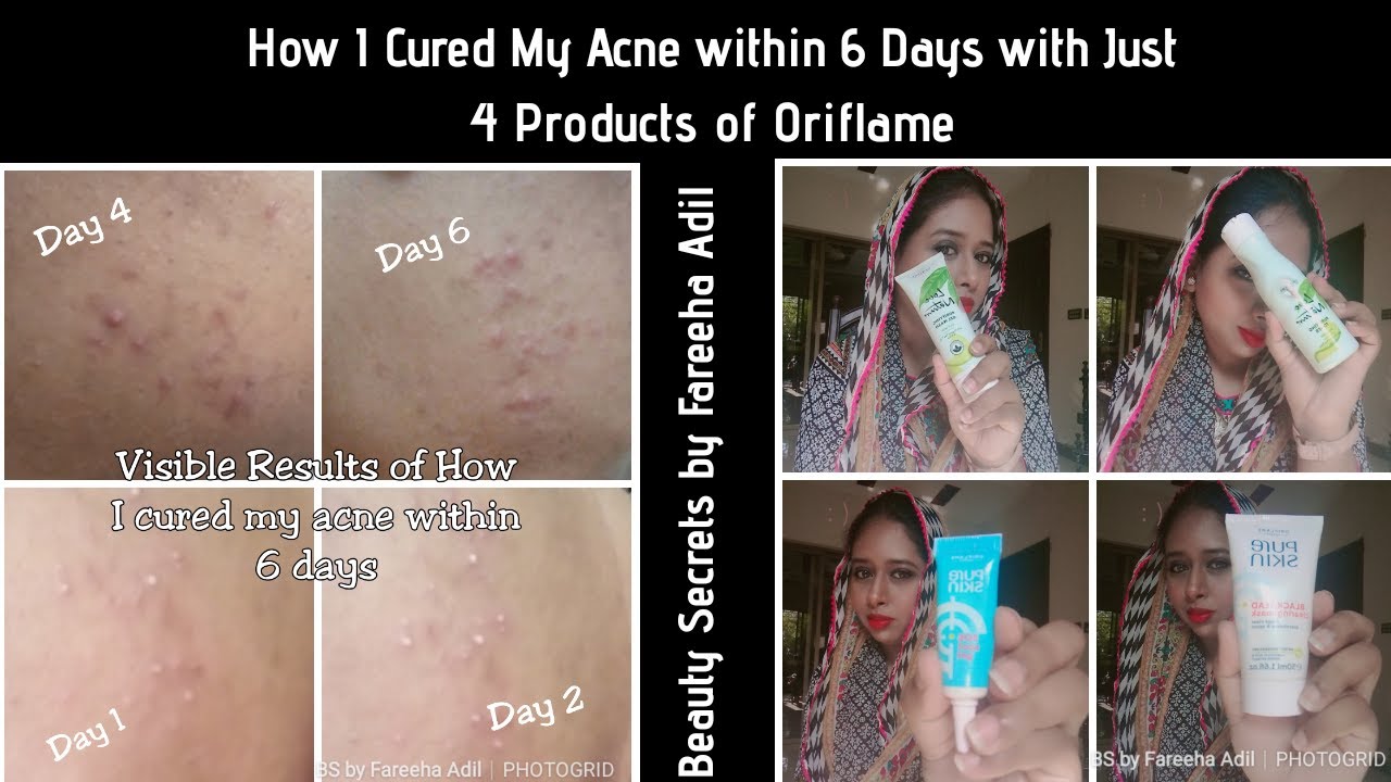 How I Cured My Acne?? Oriflame Urdu Beauty Secrets by Fareeha Adil YouTube