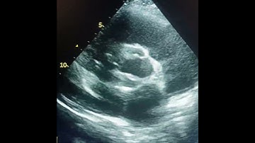 Quadricuspid Aortic Valve Echocardiography short axis view