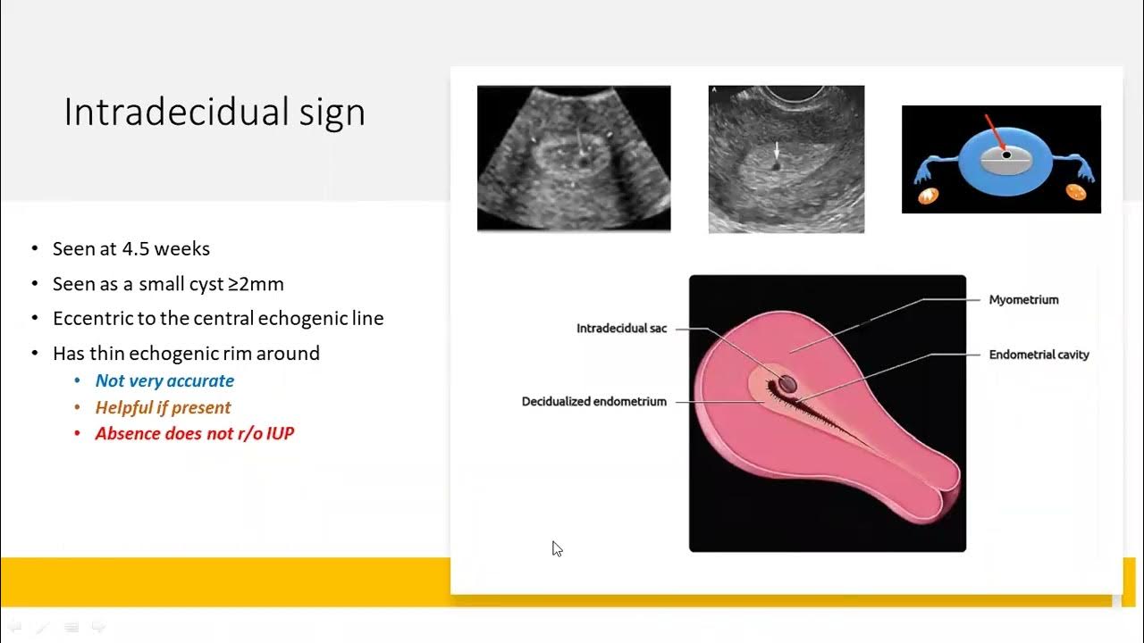 Early Pregnancy Failure YouTube early-pregnancy-failure-youtube