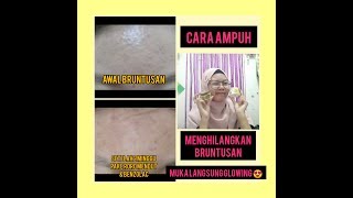 My Acne Story || Cara Ampuh Menghilangkan Bruntusan dalam 2 Minggu ✨   SKIN CARE RUTIN ✨✨