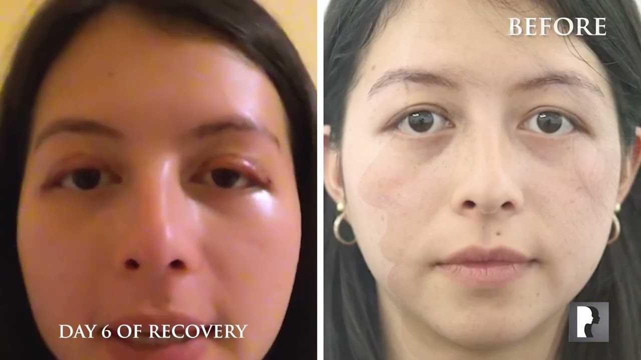 Eyelid Lift - Real Patient Story - Recovery Timelapse