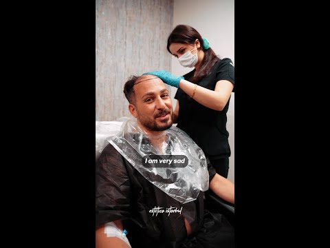 Italian Patient — Hair Transplant in Istanbul
