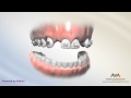 Orthodontic treatment for missing lateral incisor  braces on fake teeth