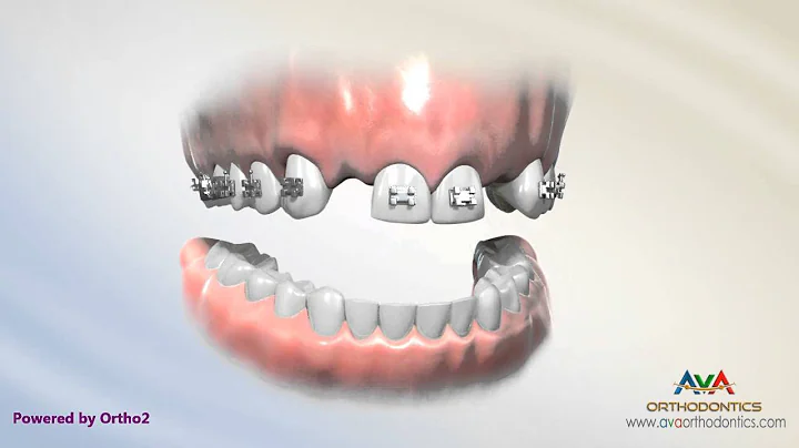 Orthodontic Treatment for Missing Lateral Incisor - Braces on Fake Teeth