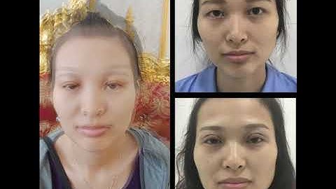 Cắt mí mini deep được 7 Ngày   cắt mí mini deep được bao lâu