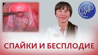 Спайки в малом тазу и трубно-перитонеальный фактор бесплодия. Рассказывает Топчая О.Ю.