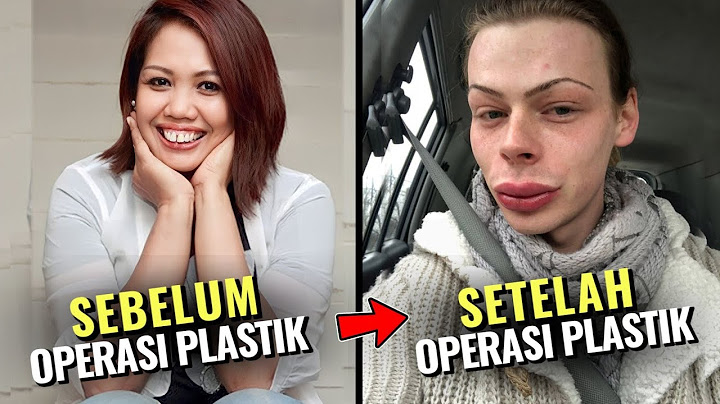 Tak Sesuai Harapan! Deretan Artis Indonesia Ini Gagal Operasi Plastik