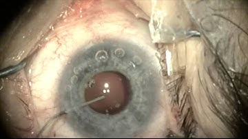 Buphthalmic eye cataract surgery by Steven G. Safran MD