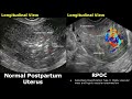 Postpartum uterus ultrasound normal vs abnormal image appearances  rpoc  retained placenta usg