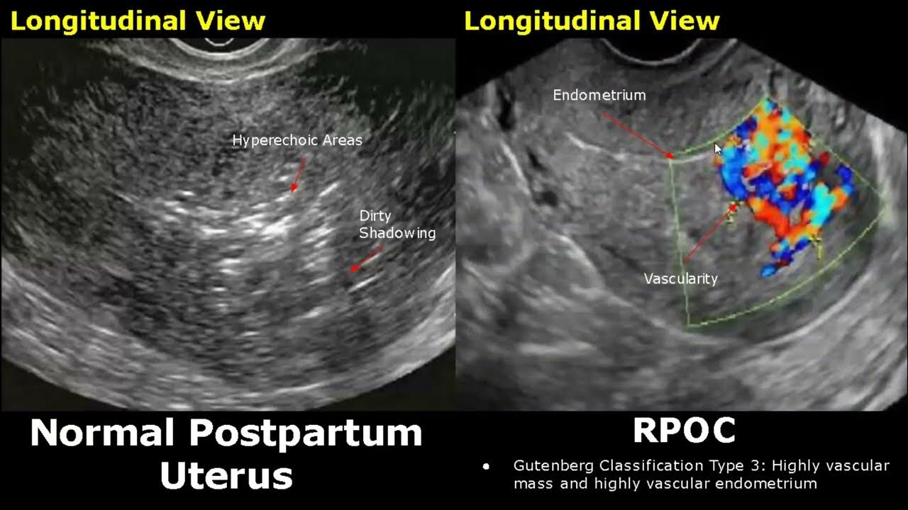 postpartum-uterus-ultrasound-normal-vs-abnormal-image-appearances