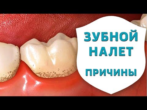 Вопрос: Как предотвратить образование зубного налета?