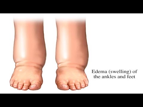 Powerful Tea Is The Best Remedy For Swollen Legs!!