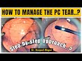 How to manage pc tear step  by step approach  dr deepak megur