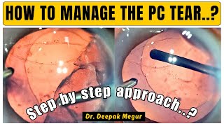How To Manage Pc Tear? Step By Step Approach - Dr Deepak Megur