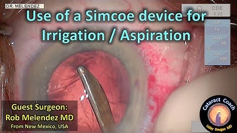 Cataract Surgery using a Simcoe Cannula with Rob Melendez MD