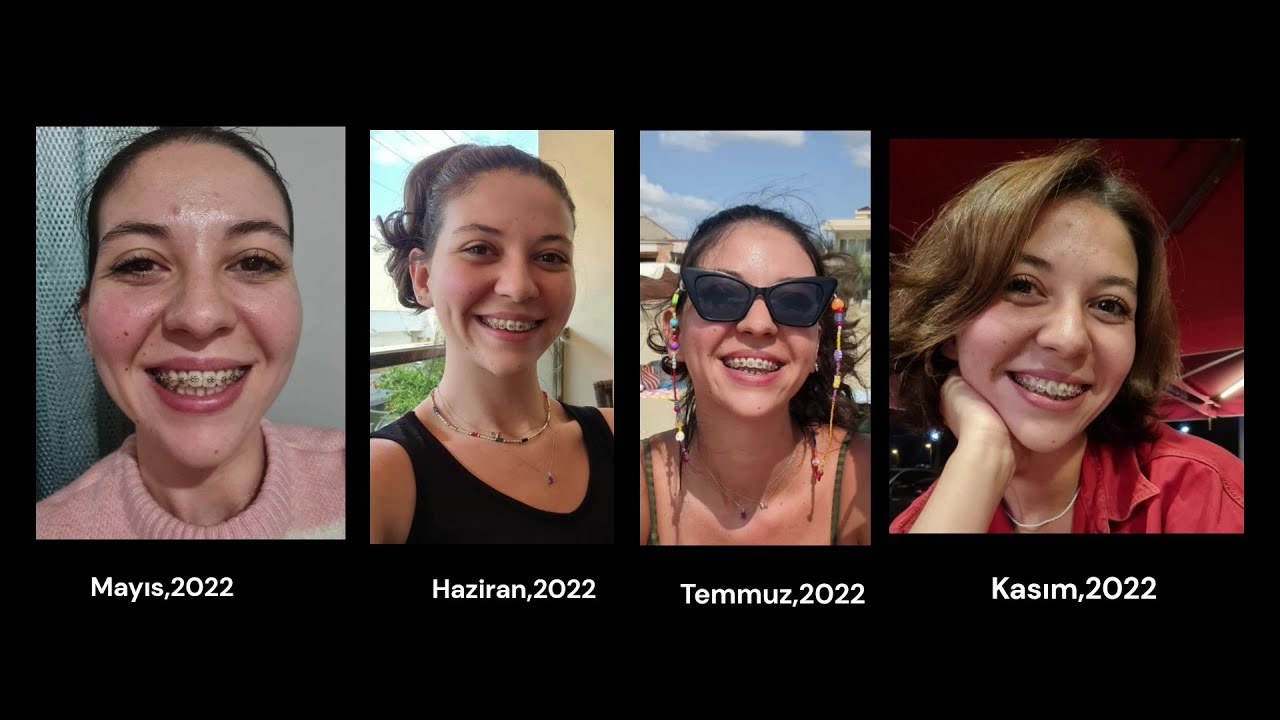 Bu Bir Ortodonti Hikayesi | Atipik yutkunma, Open bite, Dil tedavisi