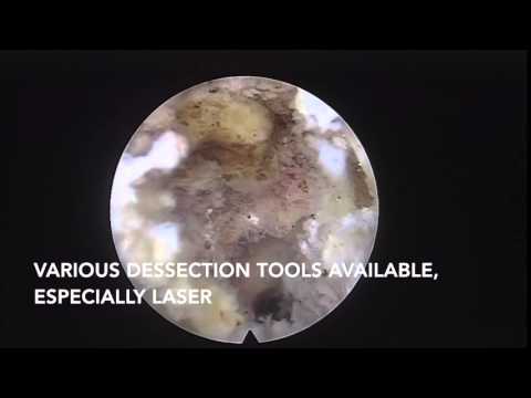 Cervical Spinal Stenosis - Mayo Clinic. 