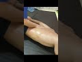 Pengobatan Skoliosis