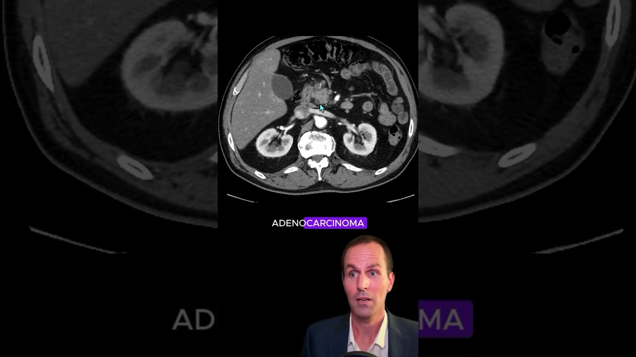 Рак поджелудочной железы с признаком двойного протока