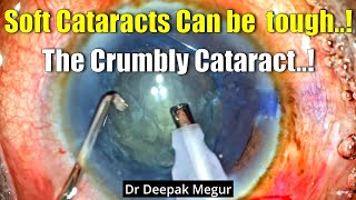 Soft Cataract Can Be Tough? The Crumbly Cataract - Dr Deepak Megur